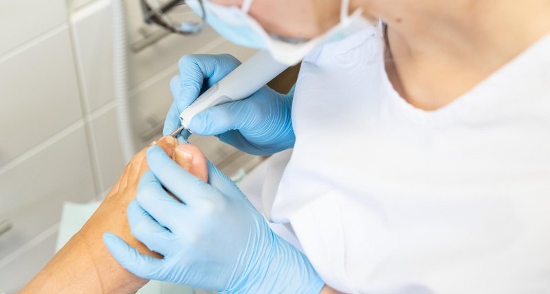 Podologin in weisser Berufskleidung behandelt mit Handschuhen und Fräser den Zehennagel einer Patientin